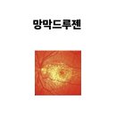 한국망막변성협회 | 망막드루젠, 드루젠의증 눈 속에 쌓이는 ‘노폐물’의 정체와 황반변성의 시작 신호