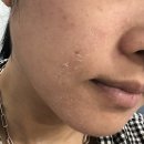 필 | 상동 바이오필관리 [뷰티포톤피아] 비포애프터 효과 완벽했던 슈렉필후기