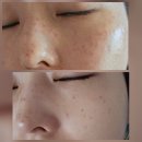 비비드에스테틱 | 옥정잡티관리 비비드엘에스테틱 5일차후기