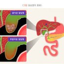 급성 만성 담낭염 효능 및 증상 원인 이미지