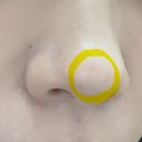 단비의원 | 강남역 가성비 여드름 염증 주사 후기(추천👍)