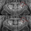 제니스치과의원 | 울산 북구 제니스치과 위쪽(상악) 완전 매복 사랑니 사례