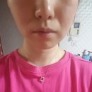 매복사랑니 발치 수술 붓기, 가격, 식사 2주차 후기(feat. 안산 담덕치과)