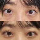 [시술] 서울 강남구청역 더멘토성형외과의원 쌍꺼풀매몰, 눈매교정, 눈밑지방재배치, 눈밑지방이식시술...