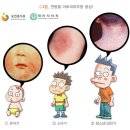 소아·성인 발병 늘어…사회생활 제약도 / 아토피 피부염 이미지