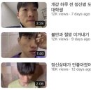 블태기 극복 어떻게 하나요