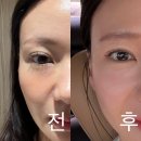 로데오사우나내피부관리실 | 압구정로데오역 청담피부과 엘란쎄 이마 관자 후기 효과 가격 전후사진