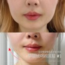 라포약국 | 라포엘 투명브이리프팅, 역대급인 신사역 성형외과 후기