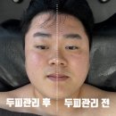 두한에너지 2 | 검단신도시 남자 두피관리는 &#39;아델라인 뷰티&amp;바디테라피&#39; 30대 탈모인의 두피관리(스칼프핏) 솔직후기