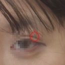 맑은동안의원 | 예비신부 피부 관리는 죽전 맑은결의원에서✨내돈내산 쥐젖 제거 후기 / 남자 제모 젠틀맥스프로 쥬베룩...