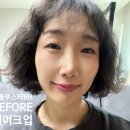 신논현스킨부스터 예쁨주의쁨의원에서 리들부스터BH 효과 후기와 후 관리법