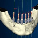 노벨덴탈 이미지