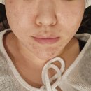 여드름 흉터 레이저 피코웨이프락셀 내돈내산 피부과 치료 2주 후기