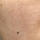 부산 민락동 여드름 피부 잘하는 곳, 위버스킨 내돈내산 후기