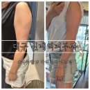 신매역 | 대구신매역피부과 리쥬엘 바디온다리프팅 후기