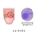 샅(서혜)육아종[Granuloma inguinale]감염성 질환, 신장비뇨기질환 이미지