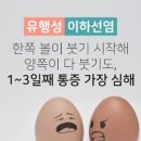 볼거리 특징과 전염이하선염 이미지