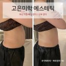 부산 웨딩 관리 [고은미학 에스테틱] 기장 뱃살 다이어트 후기
