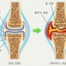 골관절염치료기 이미지
