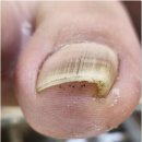 내성지구대 | 배곧내성발톱 오이도역내성발톱 관리, 네일포유 골든풋 배곧점 다녀온 후기