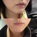 청산사우나 | [수원 동탄피부과] 내돈내산 유지력 좋은 “턱끝필러” 유스필 1cc 시술후기👀⚡️