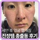 진정 | 세안 후 얼굴 빨개짐… 팩클렌저 썼다가 뒤집힌 피부 진정 후기