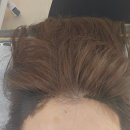 코리아(KOREA) | 강남 두피 SMP 잘하는 곳 피씨엘코리아(PCL KOREA)｜헤어라인 리얼 후기