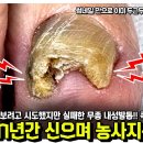 장화를 n년간 신으며 농사지은 무좀 내성발톱!! 따님께서도 어찌할 수 없었다고ㅠㅠ족보에서해결 이미지