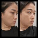 대구리프팅 V에스테틱 대구피부관리 윤곽 후기