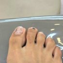 매료네일 문제성전문점 | 위례 문제성 발톱전문 네일샵 - '디에고푸스' 위례점 네일어베인 세번째 후기