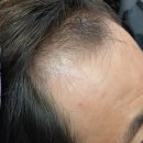부산 서대신동 미용실 탈모 고민 해결! 두피생장술 남,여 맞춤 관리 후기
