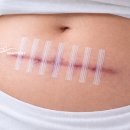 해피데이의료기기 | 3M 스테리스트립 vs 이노스트립 비교, 절개상처·갑상선수술·제왕절개 후 어떤 제품이 좋을까?