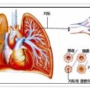 폐암! - 폐암의 증상과 원인 & 폐암 치료 이미지