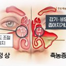 [둘째 임신일기] 급성 부비동염으로 진료받은 임산부(상남동 서울아산이비인후과)