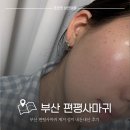 부산한의원 | 부산편평사마귀성지 서면한의원 내돈내산 제거 후기
