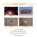 담낭선근종수술후기. 수술 1일차는 거의 통증은 없고 배꼽만 약간 아플뿐이다. 회복속도가 정말 빨라서... 이미지