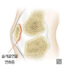 질병정보) 최악의 20대 무릎 질환 - 슬개골연골연화증 이미지