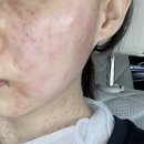 편평사마귀 성지, 인천 이삭가정의학과 얼굴 목 상반신 앞뒤 제거 후기
