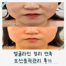 아네스피부관리 | 오산윤곽관리 아네스뷰티 3V윤곽테라피 후기
