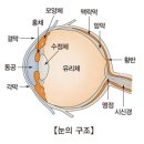 황반변성 (Macular Degeneration) 이미지