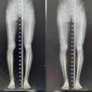 심정병원 | [재활기록] 오른쪽 무릎만 5번째 수술 후 D+6개월차 명지병원 진료 후기