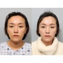 한 소프트 | 민트실리프팅 실루엣소프트 한 달 차 시술 후기 (실리프팅 특징, 주의할 점, 사후관리)