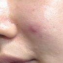 준메디케어 | 쥐젖제거패치 레이저 메디폴트 피토젠필 앰플 후기