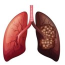 폐암 이미지
