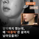 리프트성형외과의원 | 수술을 여러 번 해도 변하지 않던 이중턱, 드디어 변했어요 | 강남역 다움성형외과 브이리프트 리프팅 후기