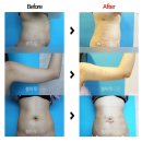 봄마루의원 | 지방흡입수술후기 완전정복 봄마루