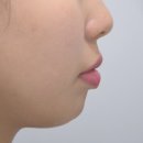 연세L치과 | 강동구에서만 16년, 예뻐지는 돌출입 치아교정, 강동구 교정치과