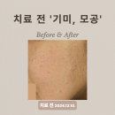 고운빔의원 | 모공, 피부결 피부과 시술 후기 #40대 여성 모공, 혈관종 완화 치료 후기