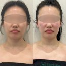 우성고덕타워 | 평택 웨딩 피부관리 평택 고덕 도도에스테틱 알테온 올인원 윤곽관리 후기