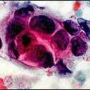 파라벤의 독성 소개-암 이미지